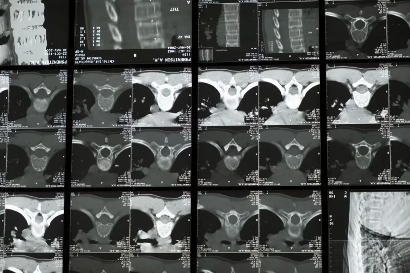 Bones Under Siege: How HIV Quietly Erodes Skeletal Health — and What You Can Do About It Now